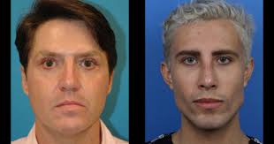 Do plastic surgeons elect to undergo cosmetic surgery more than the average american? Man Gets Plastic Surgery And Name Change To Date His Ex Girlfriend After She Obtains Restraining Order