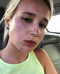 Contact клава кока on messenger. Klava Koka Postradala Pri Progulke Na Vode