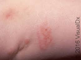 Image result for dermatitis contacta children