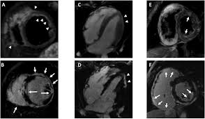Ein in der mrt nachweisbares lge ist dabei nachweislich mit einer ungünstigeren prognose und einer erhöhten rate kardialer ereignisse assoziiert. Myocardial Inflammation Detected By Cardiac Mri In Arrhythmogenic Right Ventricular Cardiomyopathy A Paediatric Case Series International Journal Of Cardiology