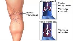 Resultado de imagen para varices