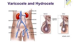 Image result for Varicocele