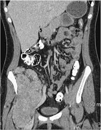 We did not find results for: A 19 Year Old Woman With Progressive Dyspnea And Multiple Pulmonary Nodules Chest
