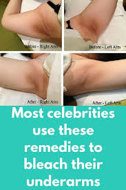 Most Celebrities Use These Remedies To Bleach Their Underarms Do You Think Celebrities Do Not Get Dark Underarms Remedy How To Whiten Underarms Dark Underarms