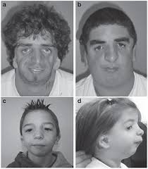 Gilles de la tourette syndrome. Treacher Collins Syndrome A Clinical And Molecular Study Based On A Large Series Of Patients Genetics In Medicine