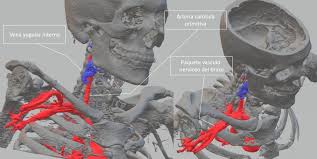 Ce sont les plus petites vertèbres. Lesiones Los Plexos Nerviosos Cervical Y Braquial