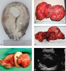 Image result for Leiomyosarcoma
