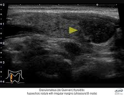 Pathology Outlines Benign