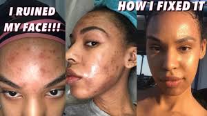 How I Ruined My Skin Chemical Burn Hyperpignmentation Face Peel And Face Peel Skin Burns Chemical Burn