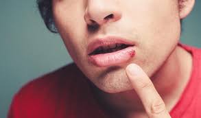 Itulah sebabnya banyak orang yang melakukan berbagai cara untuk menghilangkan jerawat. 17 Cara Menghilangkan Jerawat Secara Alami Dan Cepat Untuk Wanita Dan Pria Merdeka Com