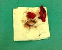 Early Stage Tailbone Cyst