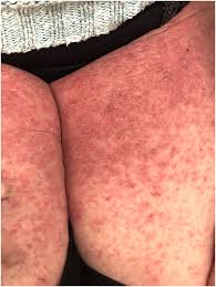 Image result for scabies in the groin area