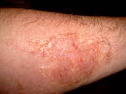 Mar 27, 2020 · the virginia creeper plant, also called american ivy, ampelopsis and woodbine, can cause a skin rash, according to the poison ivy, oak & sumac information center. Picture Upload Area Www Poisonivy Us