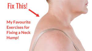 Check spelling or type a new query. Quick 4 Minute Fix For Neck Hump Youtube