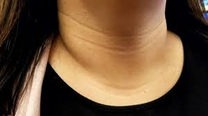 Sometimes use another scrub having bleaching agent such as lemon juice. How To Get Rid Of Tech Neck Creases In Your Neck That Aren T Caused By Age
