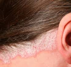 Psoríase é uma doença autoimune de longa duração caracterizada por manchas na pele. Estetica Facial Cuidados E Tratamentos Para Psoriase Artigos Cursos A Distancia Cpt