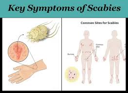 Image result for scabies symptoms