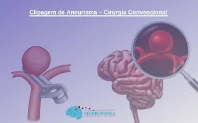 Sin embargo, el aneurisma cerebral sigue siendo un mal desconocido. Clipagem De Aneurisma Cirurgia Convencional Dr Victor Barboza Neurocirurgiao