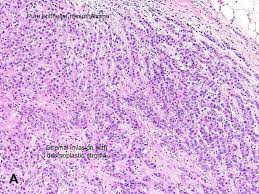 Meistens kommt es in der pleura (pleuramesotheliom), dem herzbeutel und dem peritoneum sowie an der tunica . Malignant Mesothelioma Mm American Urological Association
