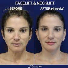 ✨Turn back the clock with a rejuvenating facelift! ✨A refreshed, youthful  appearance awaits as you erase years off your face, revealing a more  vibrant and confident you. ✨It's time to look as
