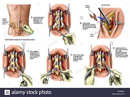 Back Surgery L5 S1 Lumbar Discectomy And Spinal Fusion Stock Photo Royalty Free Image 7711632 Alamy Spinal Fusion Spinal Fusion Surgery Back Surgery