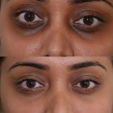 Dark Circles Periorbital Therapists In Grays Essex