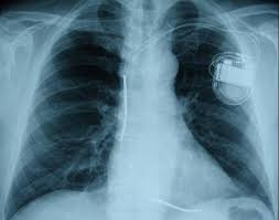 Das röntgen ist eine häufige untersuchungsmethode, bei der ionisierende röntgenstrahlung zum einsatz kommt. Kardiologie Herzschrittmacher Defibrillatoren Kardiale Resynchronisations Therapie