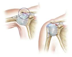 Smerter og nedsatt funksjonalitet i skulder og ofte arm. Skulder Impingement Bliv Smertefri Uden Operation Smertefribevaegelse Behandling