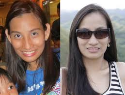 Black And White Bleaching Cream Results Some Of Glutathione Injectable Before And After Pics Results Are Not Typical Www Wh Skin Bleaching Cream Skin Care Routine Steps Glutathione Before And After