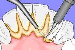 Hier erfahren sie welche mittel wirklich funktionieren. Zahnstein Zahnbelag Selber Entfernen Methoden Risiken