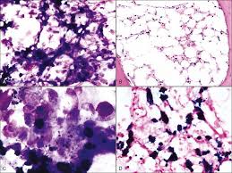 The genetic mutations associated with these syndromes can affect all of the. Disorders Of Bone Marrow Veterian Key