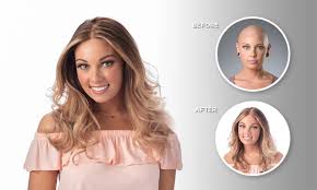 Letting it hang loose with no additions or accessories to weight it down or add unnecessary tension, is the kindest and most highly recommended hairstyle for anyone with. Isabelle Restored Her Hair After Losing It To A Hair Loss Condition Called Alopecia Areata Hair Club