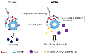 Image result for Anhidrosis
