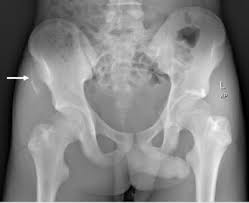 The tensor fasciae latae and sartorius muscles of the thigh have their origins at the anterior superior spine. Anterior Superior Iliac Spine Medicine Health