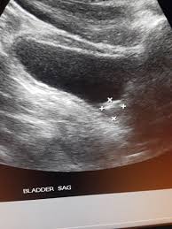 Bladder Stone Ultrasound Ultrasound School Sonography
