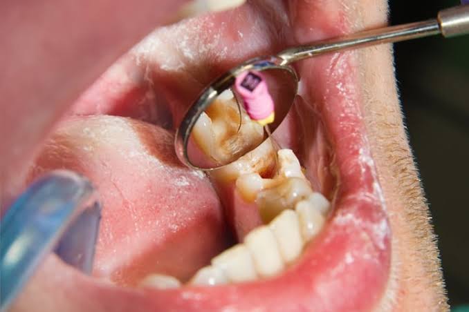 Root Canal Treatment care 3