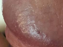 Puntito Rojizo En El Glande Que Me Inquieta Dermatologo Net