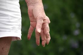 Rheumatoide Arthritis Eine Ubersicht Medumio