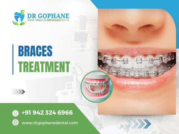 Braces Treatment In Yavatmal product image