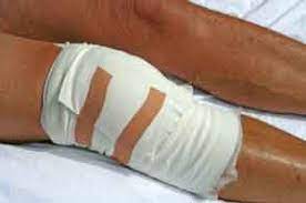 What is a locked knee? How To Unlock A Locked Knee