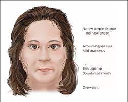 Information Prader Willi Syndrome