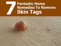 How To Safely Remove Skin Tags With Home Skin Tag Removal Skin Tags Home Remedies Home Remedies