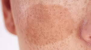 El melasma es una enfermedad que produce unas manchas simétricas principalmente en la cara la predisposición personal y hereditaria a padecer esta enfermedad es una de las causas principales. Manchas Que Empeoran En Verano Que Es El Melasma