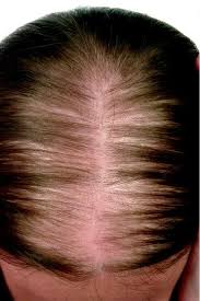 Oral contraceptives (ocp) in combination with spironolactone. Female Pattern Hair Loss Springerlink