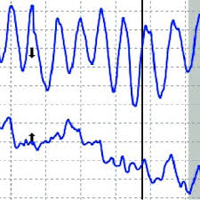 False negatives (where the test says you're not pregnant, but you are) are more common. Pdf Polygraph Examination Of Pregnant Women Dilemmas And Recommendations