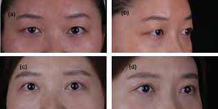 A Modified Procedure for Single-eyelid Asian Females with Lacrimal Gland  Prolapse: Lacrimal Gland Reposition combined with Fat Transposition in  Double-eyelid Operation