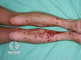 Image result for Pyoderma Gangrenosum