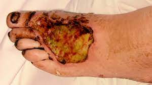 Chronic obstructive pulmonary disease is a lung disease that is characterized by a persistent reduction of airflow. Gangrene Types Symptoms And Diagnosis