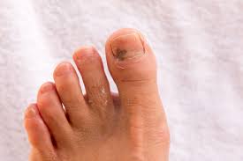 Image result for onychomycosis