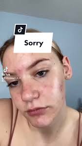 Sanfte Hautpflege-Tipps für Akne und Pickel